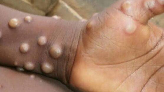 Benue State on Alert as Residents Report Suspected Mpox Cases – Government Responds Fast